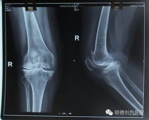 膝关节置换医院排名_膝关节置换图片