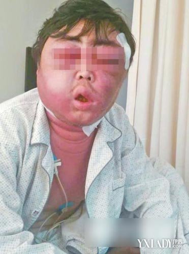 男子被蚊子叮一口脸肿成球 惨不忍睹