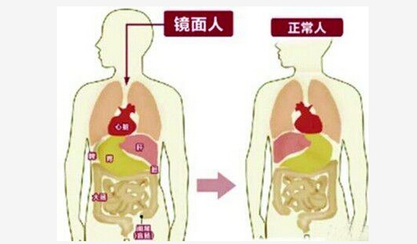 东莞现镜面人 心脏在右肝胆在左