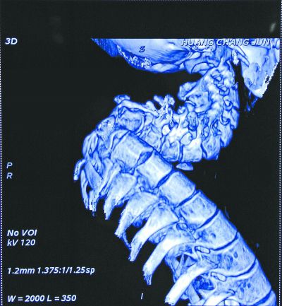 湖北小伙脊柱弯曲像麻花 最大心愿：挺直腰杆